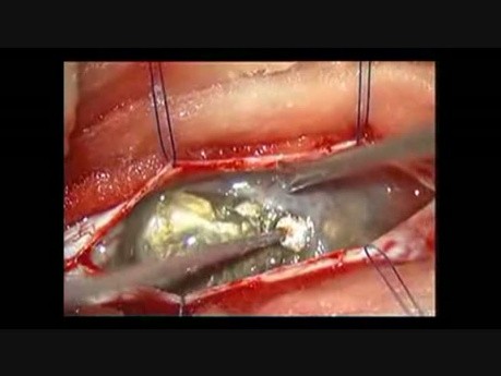 Epidermoide intradural espinal: extirpación microquirúrgica