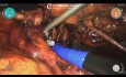 Nefrectomía radical robótica Versius