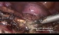 Histerectomía total laparoscópica para útero enorme: consejos y trucos