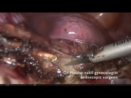 Histerectomía total laparoscópica para útero enorme: consejos y trucos
