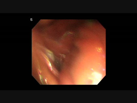 DSE para tumor submucoso gástrico