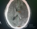 Craniectomía descompresiva en infarto maligno de la arteria cerebral media