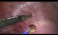 Endometriosis