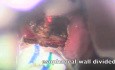 Diverticulotomía - endoscopia