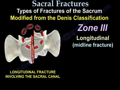 Clasificaciones de fracturas sacras 