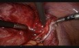 Manejo laparoscópico del quiste dermoide ovárico