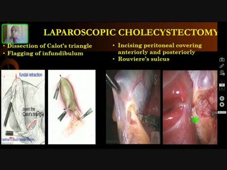 Colecistectomía laparoscópica