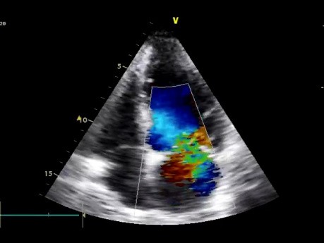 Rotura del musculo papilar - causa de insuficiencia mitral aguda