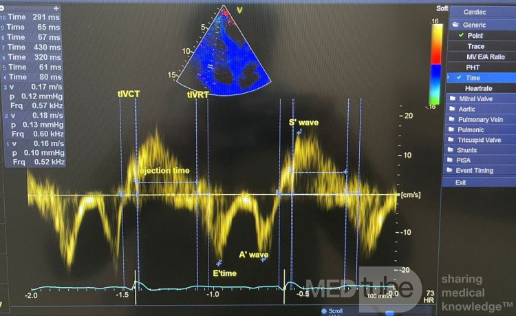 Función diastólica del VD mediante Doppler tisular e índice Tei