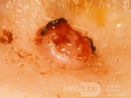 Queratoacantoma