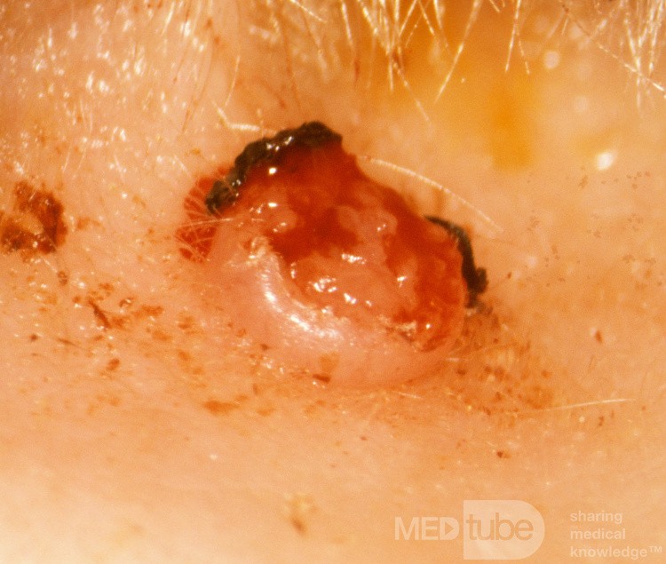 Queratoacantoma
