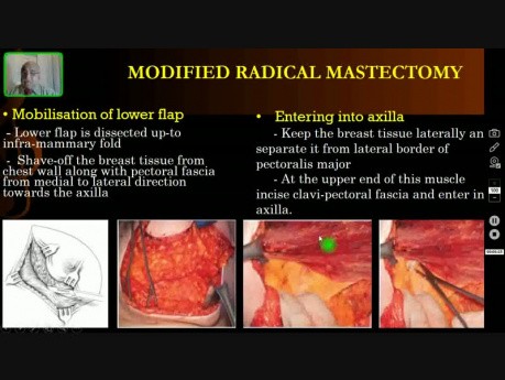 Aspectos Teóricos de la Mastectomía Radical Modificada