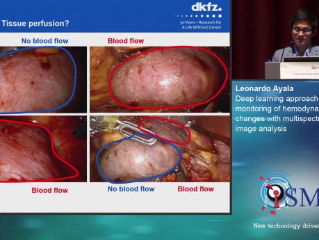 Enfoque de aprendizaje profundo para el monitoreo en vivo de cambios hemodinámicos con análisis de imágenes multiespectrales - SMIT 2019