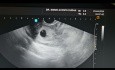 Paciente con embarazo gemelar espontáneo