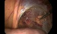 Reparación laparoscópica de la hernia inguinal derecha