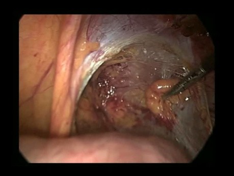 Reparación laparoscópica de la hernia inguinal derecha