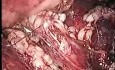 Ureterolitotomía laparoscópica retroperitoneal después de una LEOC fallida