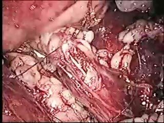 Ureterolitotomía laparoscópica retroperitoneal después de una LEOC fallida