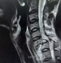 Abordaje Anterior de Cloward para Fractura Cervical AO Spine Tipo C con Síndrome de Brown Sequard