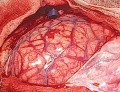 Craniectomía descompresiva en infarto maligno de la arteria cerebral media