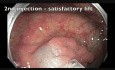 Perforación del colon tras RME - C