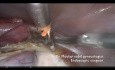 Anexectomía para el fibroma ovárico