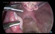 Miomectomía laparoscópica 1 Fibroma de la pared lateral