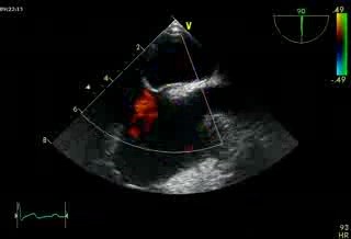 Foramen oval permeable (FOP)