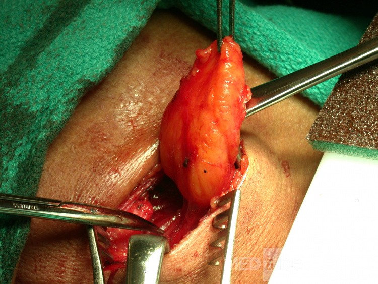 Lipoma del cuello
