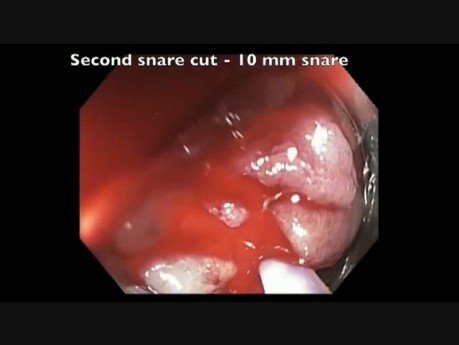 Complicaciones de la resección mucosa endoscópica (RME) - sangrado del ciego - video C
