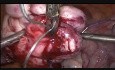 Miomectomía de miomas uterinos de la pared posterior