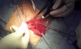 Reparación de hernia inguinal con malla semiabsorbible