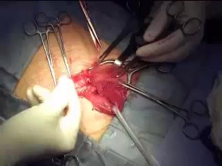 Reparación de hernia inguinal con malla semiabsorbible