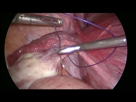 Ooforectomía derecha Video Laparoscopica 