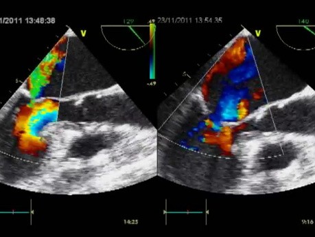 Insuficiencia mitral funcional eclipsada como causa principal de edema pulmonar agudo