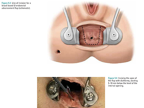 Cirugía de colon y recto - Operaciones anorrectales