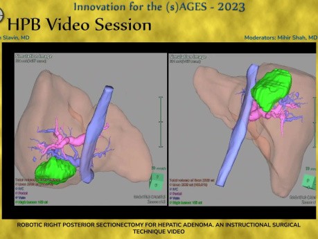 Seccionectomía posterior derecha robótica para adenoma hepático. Técnica quirúrgica instructiva.
