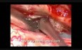 Tumor de la médula espinal - Meningioma intradural espinal - Escisión microquirúrgica