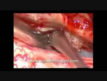 Tumor de la médula espinal - Meningioma intradural espinal - Escisión microquirúrgica