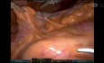 Colectomía derecha robótica con CME para cáncer de colon derecho