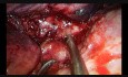 Lobectomía de manga superior derecha de cáncer de pulmón enorme operada por Uniportal VATS