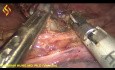 Esofagectomía toraco-laparoscópica - Parte torácica 5