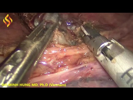 Esofagectomía toraco-laparoscópica - Parte torácica 5