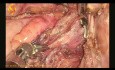 Un tumor gigante que ocupa el área pélvica retroperitoneal
