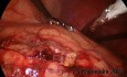 Carcinoma de riñón
