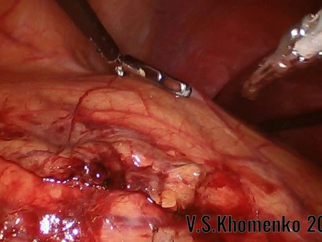 Carcinoma de riñón