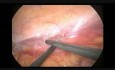 Nefrectomía radical laparoscópica de cáncer de riñón