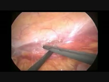 Nefrectomía radical laparoscópica de cáncer de riñón