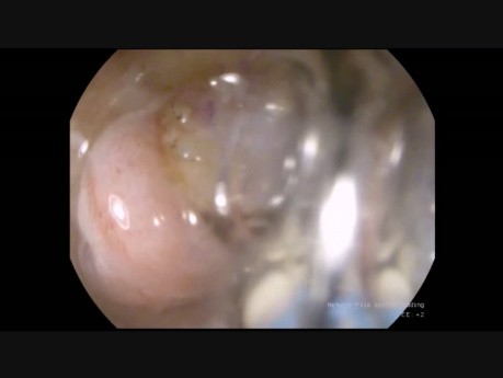 Disección Endoscópica Submucosa de Lipoma Duodenal