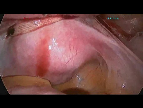 Cerclaje cervical laparoscópico con cinta de Mersin a las 12 semanas de embarazo